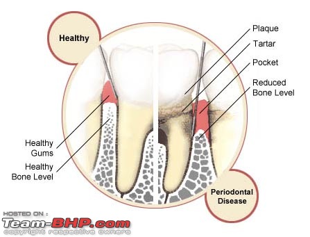 Calling doctors/dentists/specialists on Team-BHP to provide free consultations-periodontal.jpg