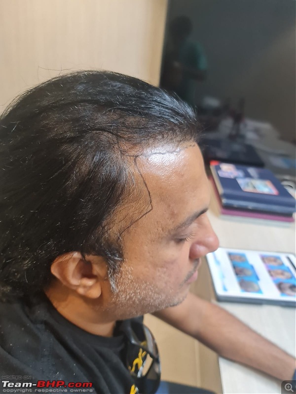 The Hair Transplant Thread-0b.jpg