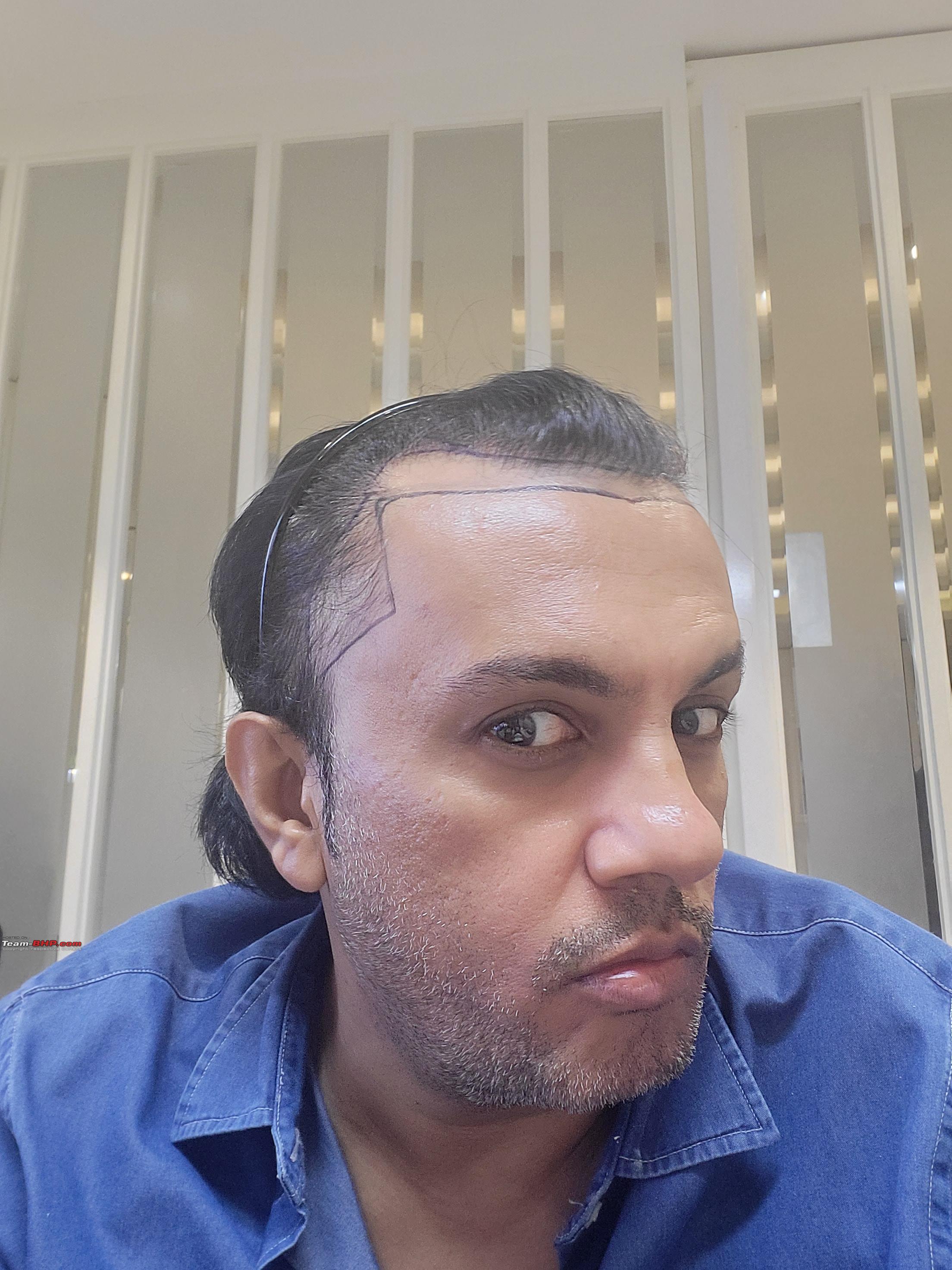 Best hair transplant clinic in Delhi NCR (Gurgaon)- Eugenix Hair Sciences |  Watch Mr Nitesh Ranjan share his experience and result after getting a hair  transplant surgery from Eugenix Hair Sciences. Eugenix